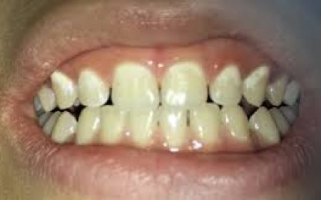 كيف تحمي نفسك من التسوس؟